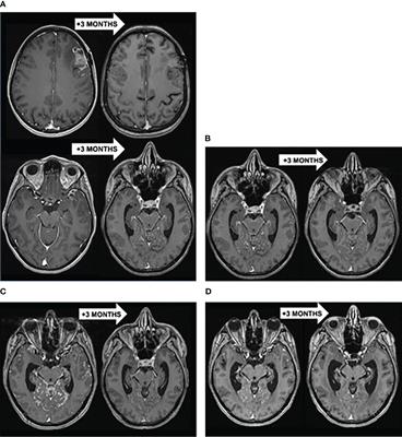 Long-term response to sequential anti-HER2 therapies including trastuzumab-deruxtecan in a patient with HER2-positive metastatic breast cancer with leptomeningeal metastases: a case report and review of the literature